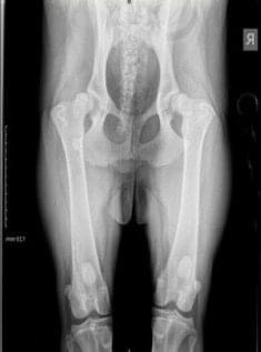 18 month old severe hip dysplasia